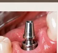 Instalação do implante