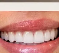 Resultado final do tratamento
