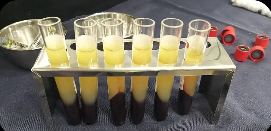 Tubos de L-PRF centrifugados, com separação da fibrina e das hemácias